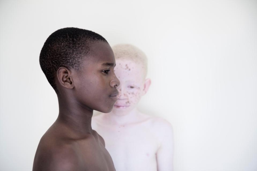 Blancura mortal: Retratos increíbles de los albinos de Tanzania