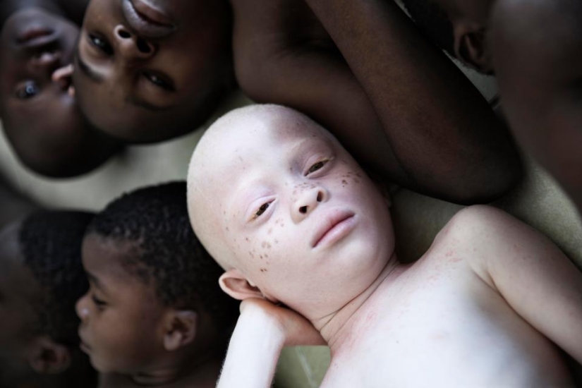 Blancura mortal: Retratos increíbles de los albinos de Tanzania