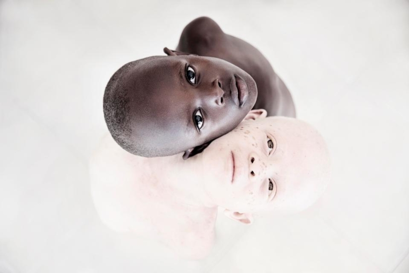 Blancura mortal: Retratos increíbles de los albinos de Tanzania