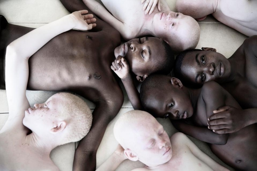 Blancura mortal: Retratos increíbles de los albinos de Tanzania