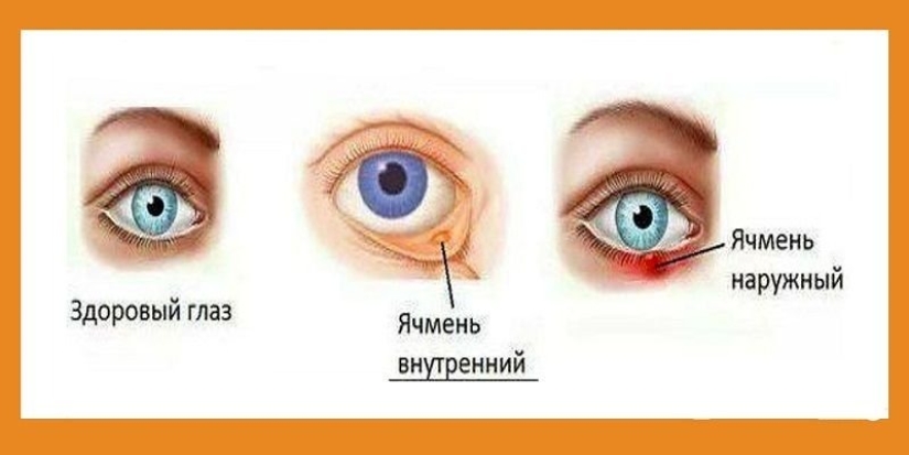 Cebada en el ojo, qué tipo de enfermedad es esta. ¿Qué causa la cebada?