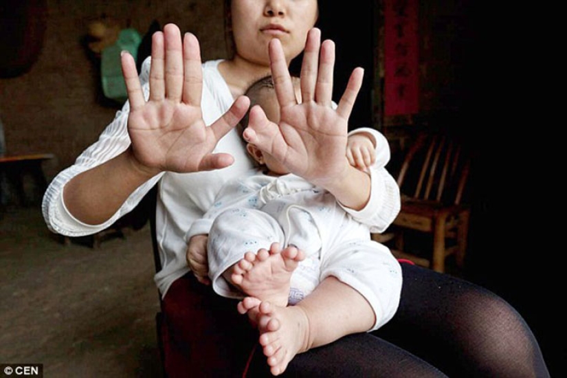 Chinese boy born with 31 fingers Chinese boy born with 31 fingers