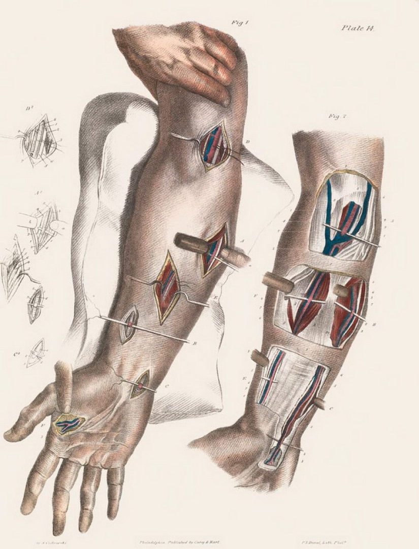 Cómo se hacían las cirugías a principios del siglo pasado