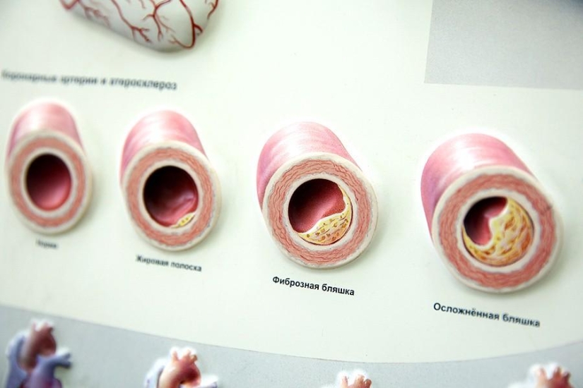 Cuestiones del Corazón, u Operación sin Cortes