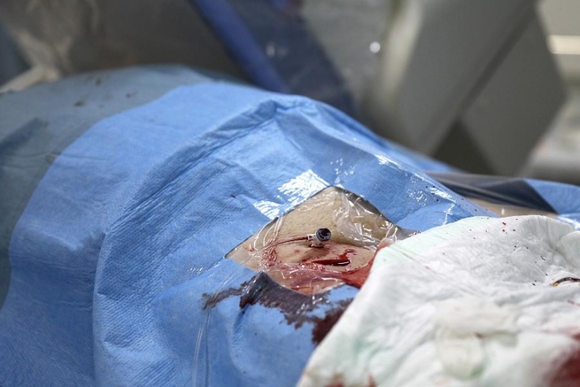 Cuestiones del Corazón, u Operación sin Cortes