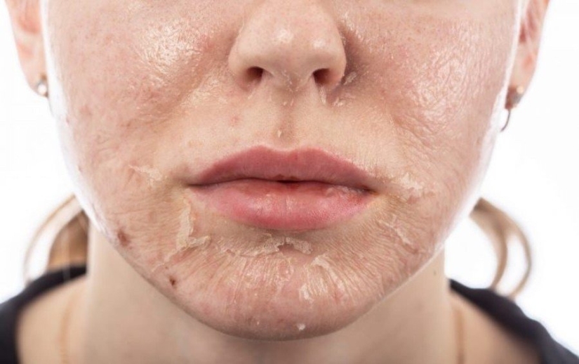 Don’t go to the beautician: 9 most dangerous and useless beauty procedures