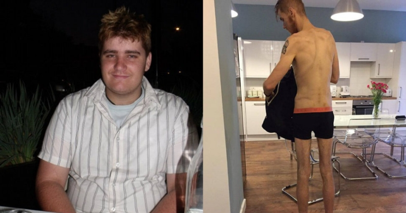 Everything is good in moderation: an obese man lost half his weight and became like Koshchei the Immortal