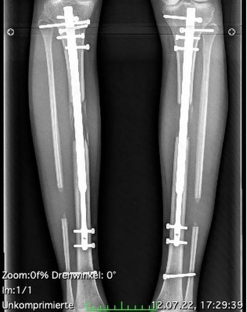 German model lengthened her legs by 14 cm and is not going to stop