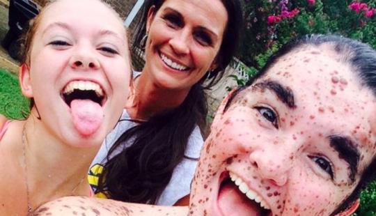 Girl with rare skin condition takes pride in being different Girl with rare skin condition takes pride in being different