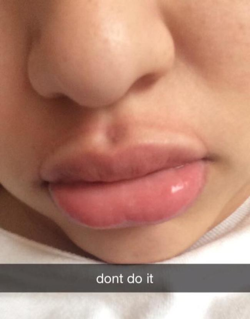 Girls try to make their lips plump like a TV star. It doesn't turn out very... Girls try to make their lips plump like a TV star. It doesn't turn out very...