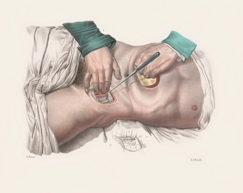 How were surgeries done at the beginning of the last century