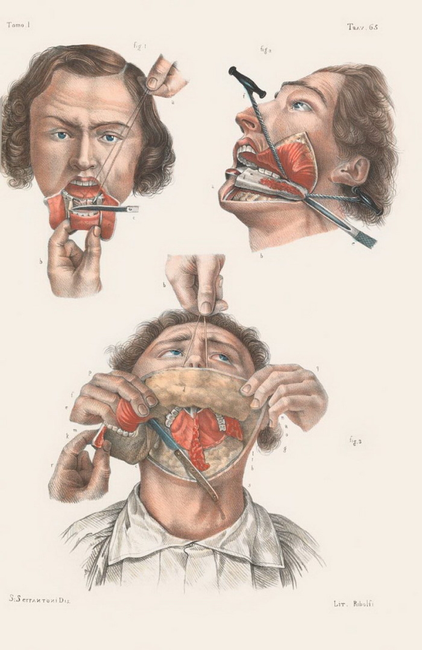 How were surgeries done at the beginning of the last century