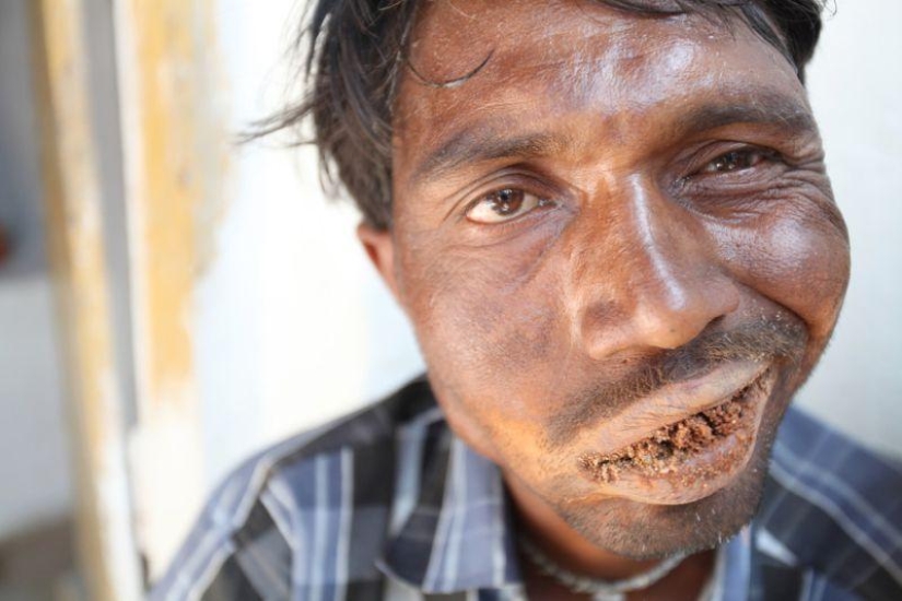 Indian man eats bricks and stones for 20 years Indian man eats bricks and stones for 20 years