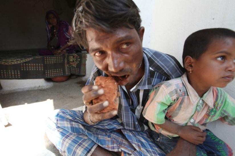Indian man eats bricks and stones for 20 years Indian man eats bricks and stones for 20 years