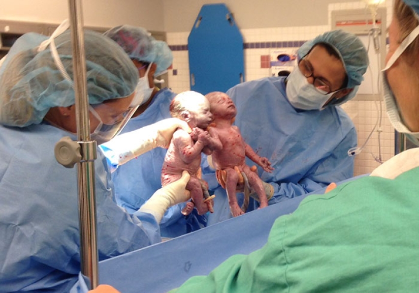 Inseparable twins holding each other's hand at birth, two years later