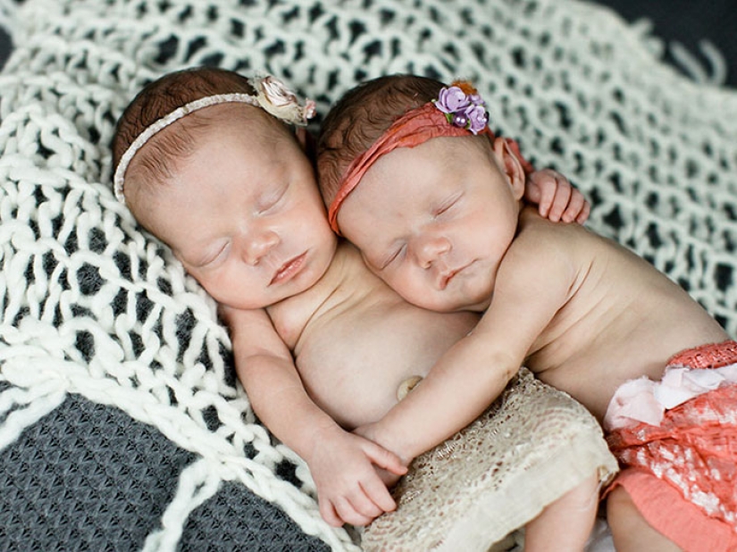 Inseparable twins holding each other's hand at birth, two years later