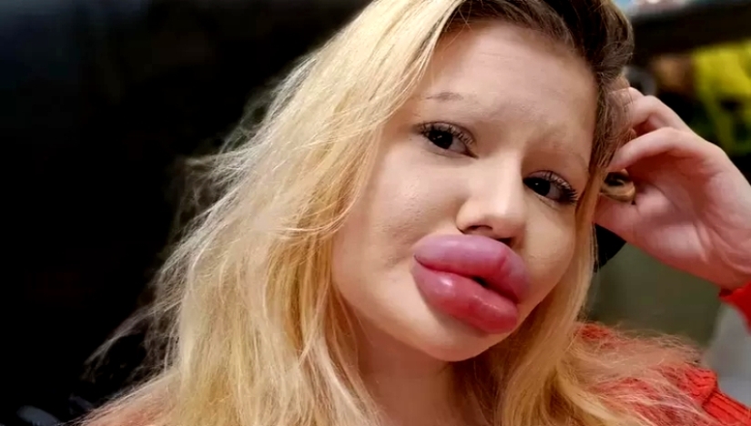 La chica con los labios más grandes del mundo decidió agrandar sus pómulos La chica con los labios más grandes del mundo decidió agrandar sus pómulos