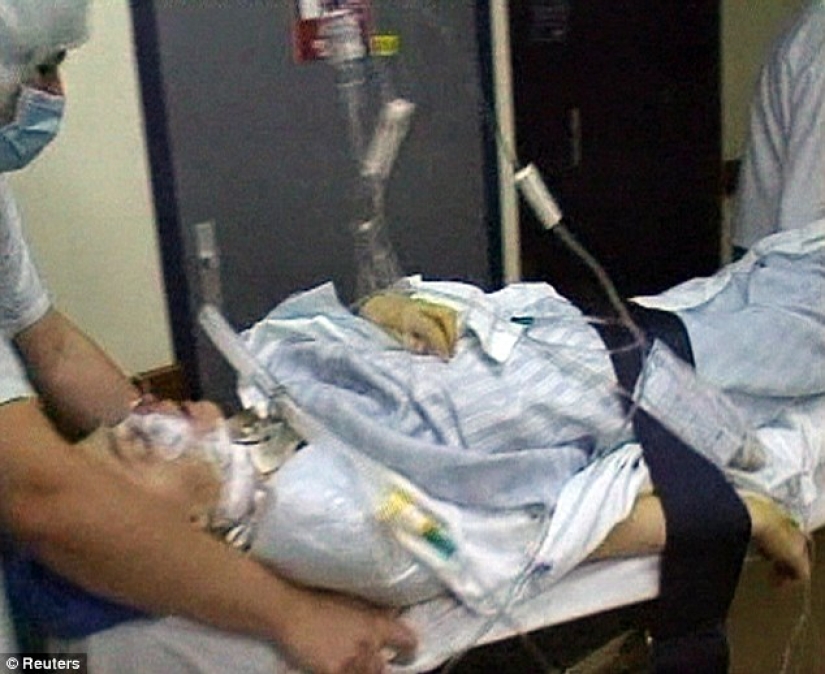La primera mujer con cara trasplantada murió de cáncer causado por medicamentos contra el rechazo La primera mujer con cara trasplantada murió de cáncer causado por medicamentos contra el rechazo