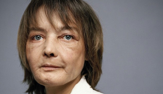 La primera mujer con cara trasplantada murió de cáncer causado por medicamentos contra el rechazo