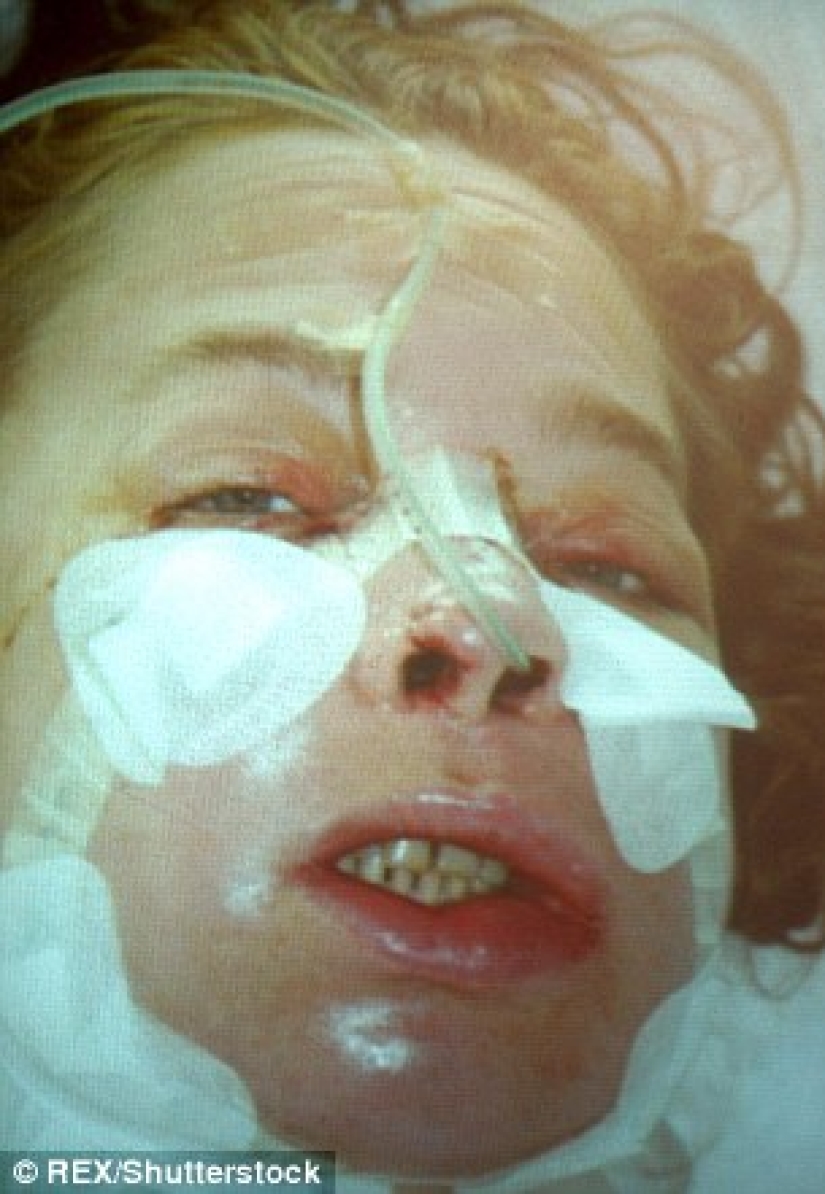 La primera mujer con cara trasplantada murió de cáncer causado por medicamentos contra el rechazo La primera mujer con cara trasplantada murió de cáncer causado por medicamentos contra el rechazo