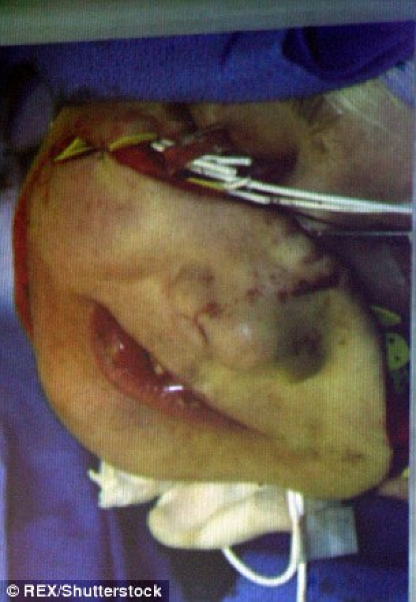 La primera mujer con cara trasplantada murió de cáncer causado por medicamentos contra el rechazo La primera mujer con cara trasplantada murió de cáncer causado por medicamentos contra el rechazo