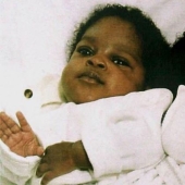 Los gemelos siameses separados en la infancia continúan durmiendo de la misma manera que antes de la operación