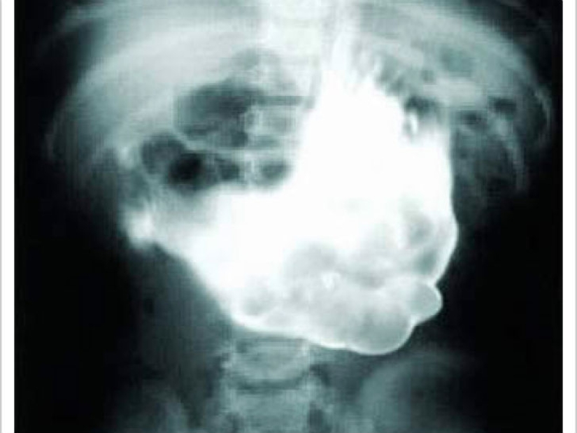 Los objetos más espeluznantes que se han encontrado en un estómago humano