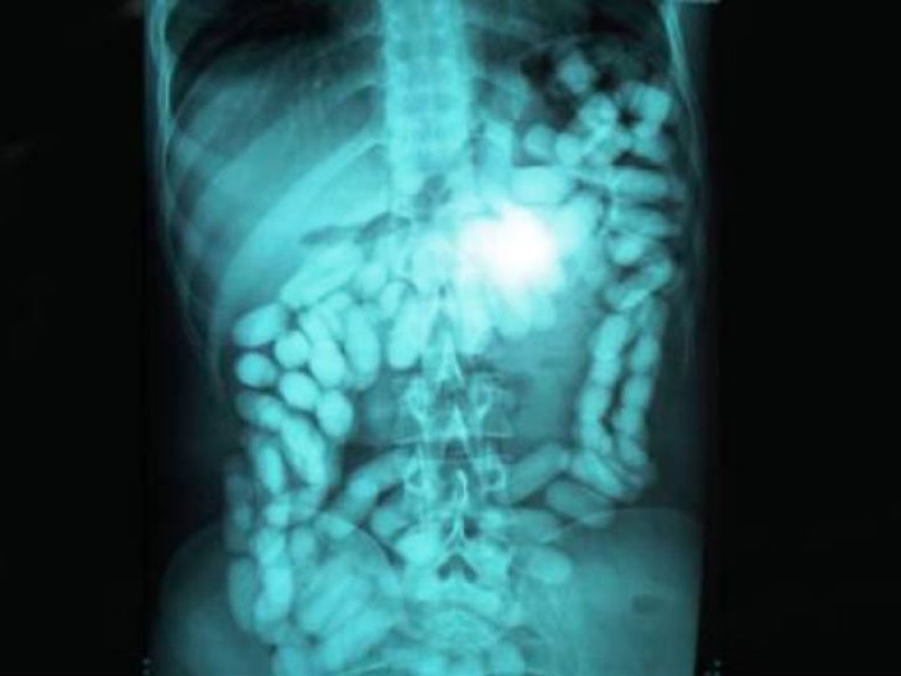 Los objetos más espeluznantes que se han encontrado en un estómago humano