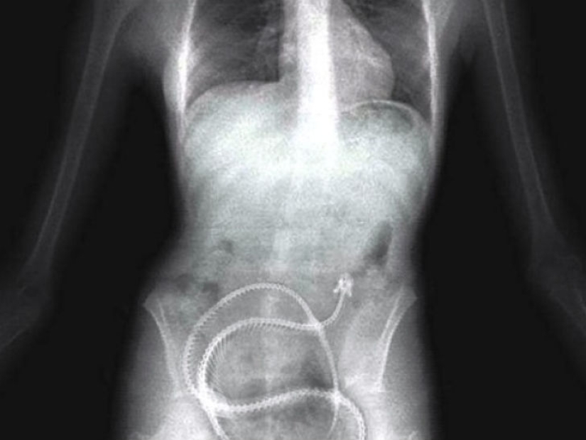 Los objetos más espeluznantes que se han encontrado en un estómago humano