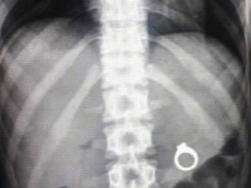 Los objetos más espeluznantes que se han encontrado en un estómago humano