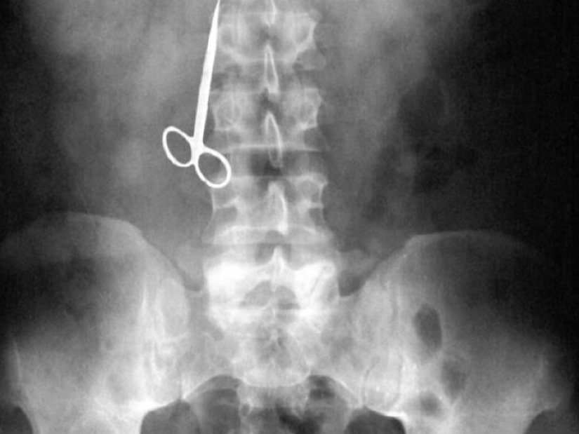 Los objetos más espeluznantes que se han encontrado en un estómago humano