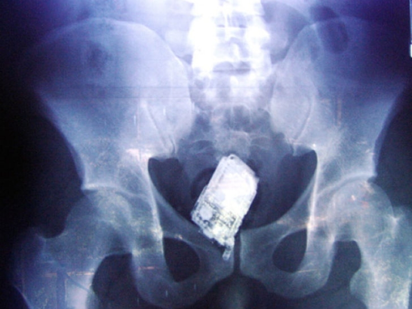 Los objetos más espeluznantes que se han encontrado en un estómago humano