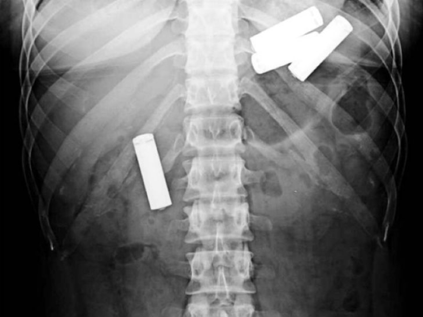 Los objetos más espeluznantes que se han encontrado en un estómago humano