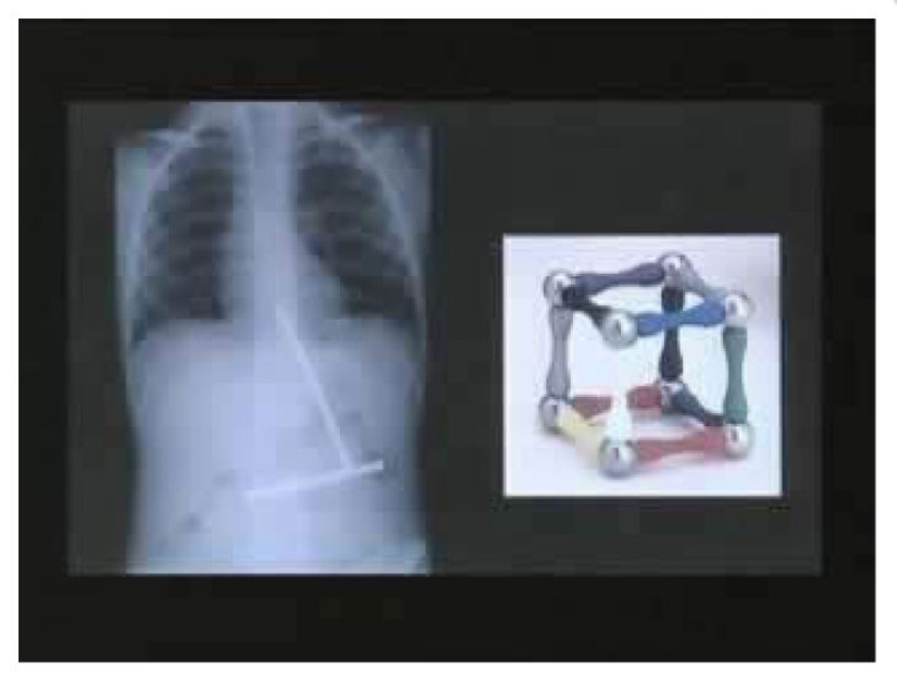 Los objetos más espeluznantes que se han encontrado en un estómago humano