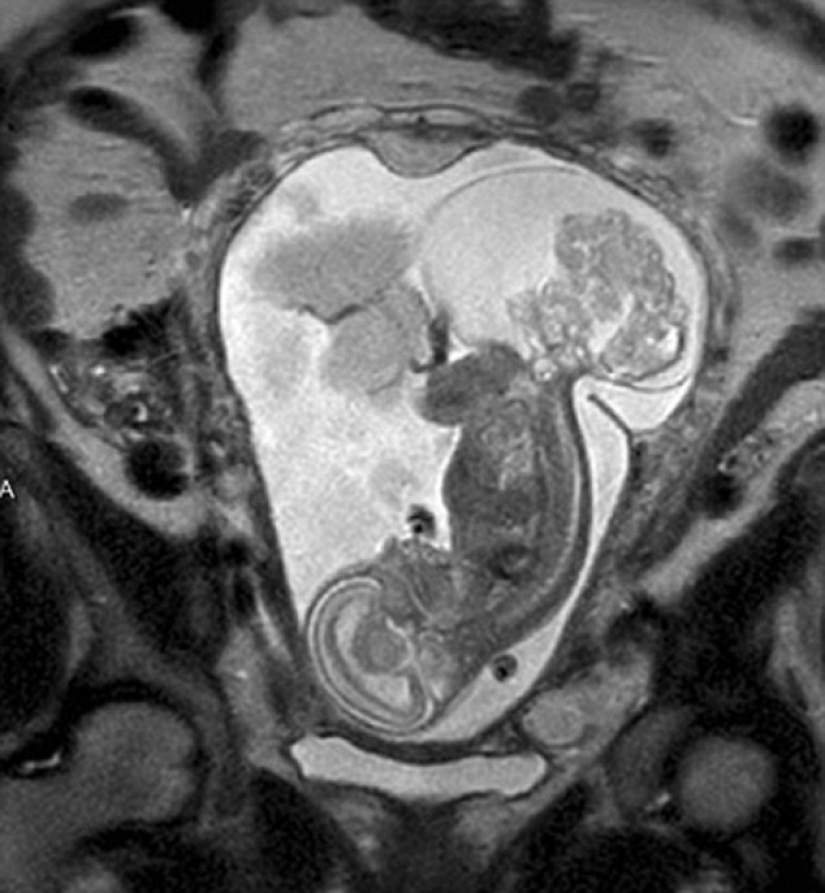 Nacido dos veces: los médicos sacaron al bebé del útero para operarlo y traerlo de vuelta