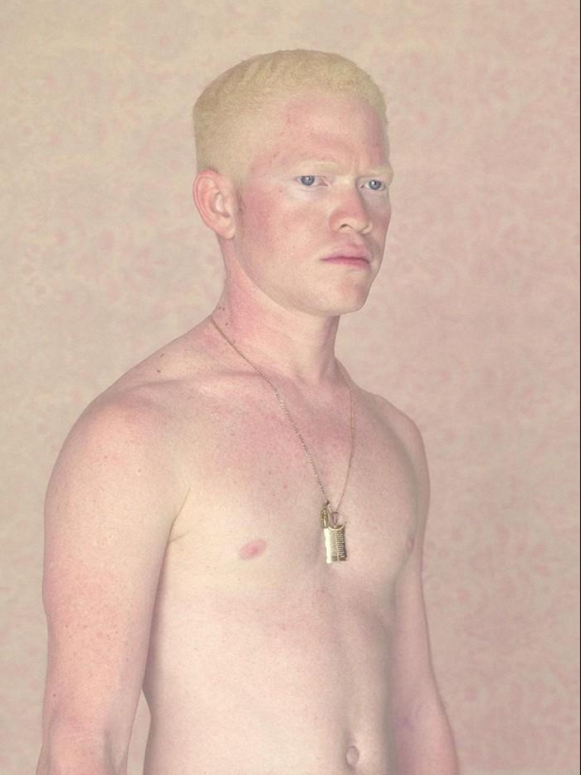 Not like everyone else: albino people