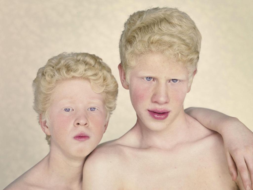 Not like everyone else: albino people