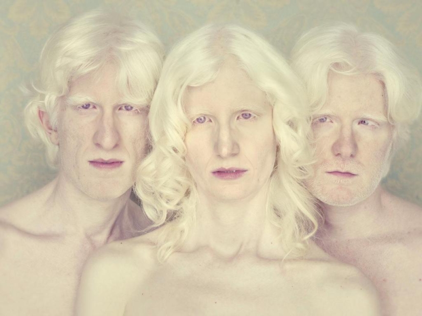 Not like everyone else: albino people