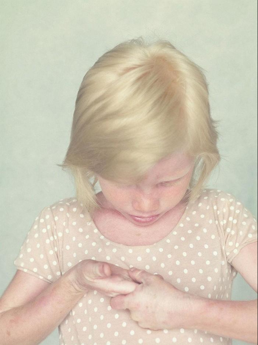 Not like everyone else: albino people