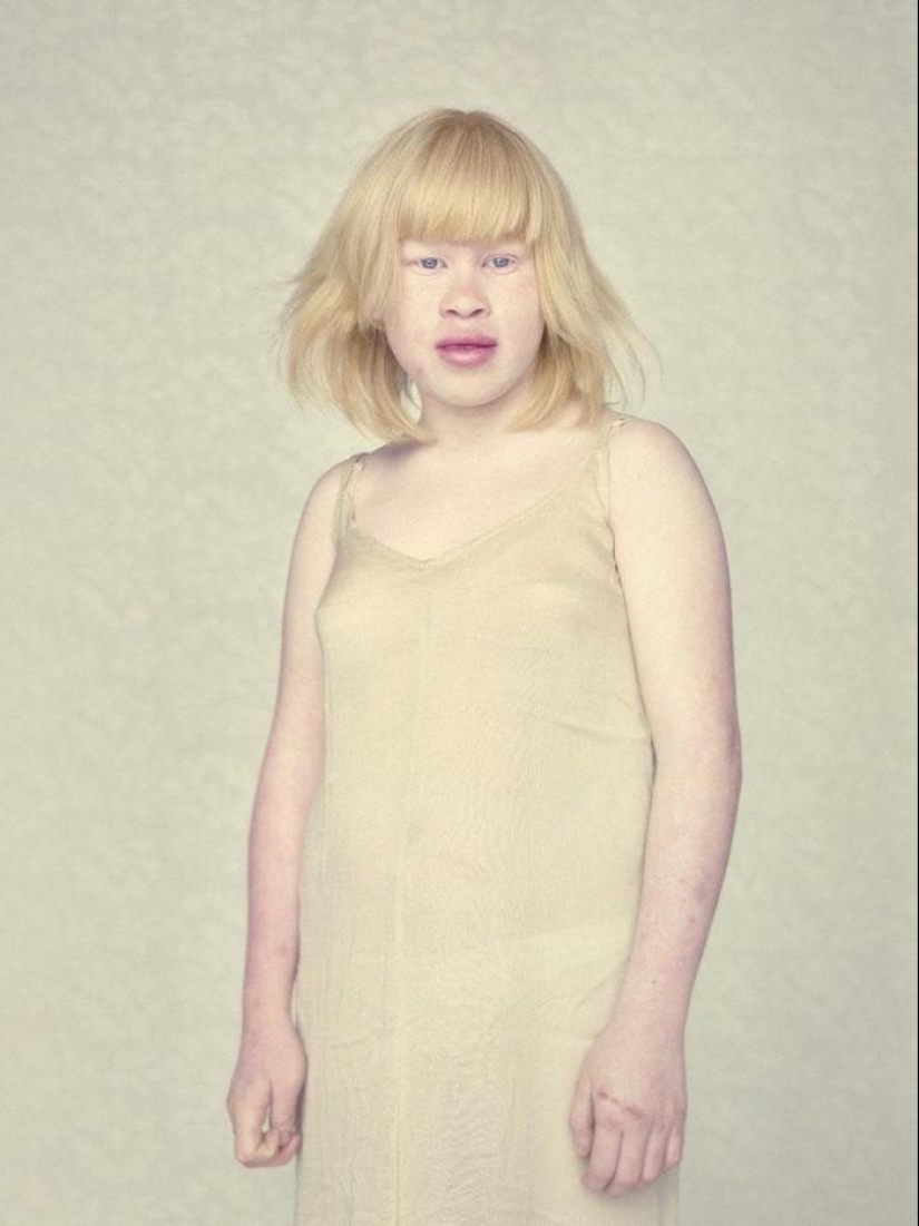 Not like everyone else: albino people