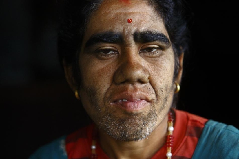 Personas lobo, víctimas de hipertricosis, se sometieron a depilación láser