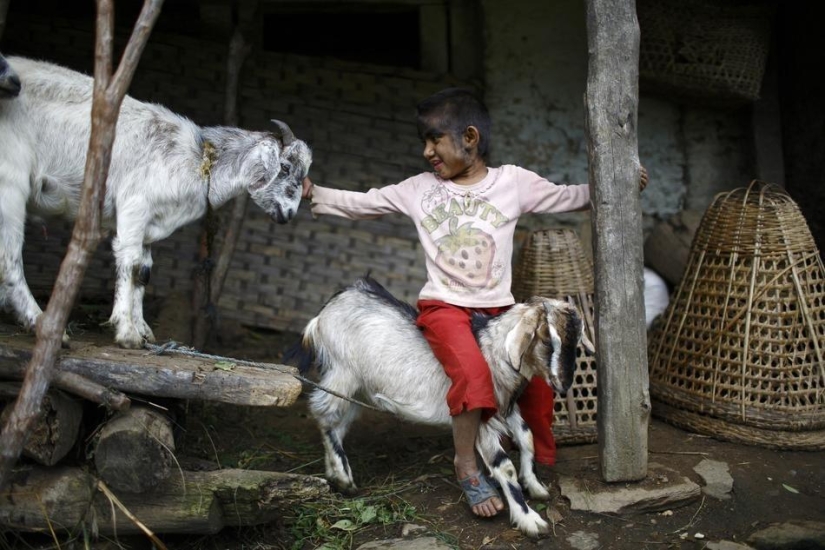 Personas lobo, víctimas de hipertricosis, se sometieron a depilación láser