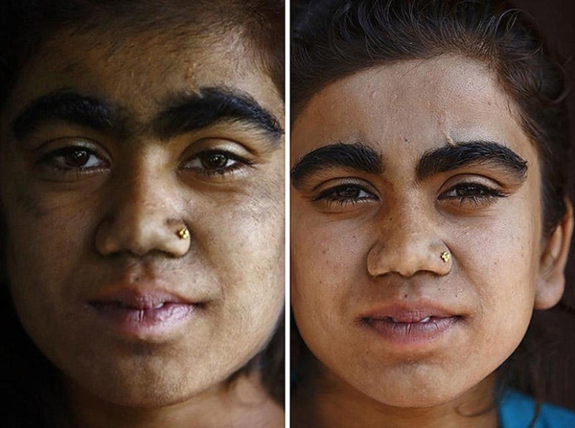Personas lobo, víctimas de hipertricosis, se sometieron a depilación láser