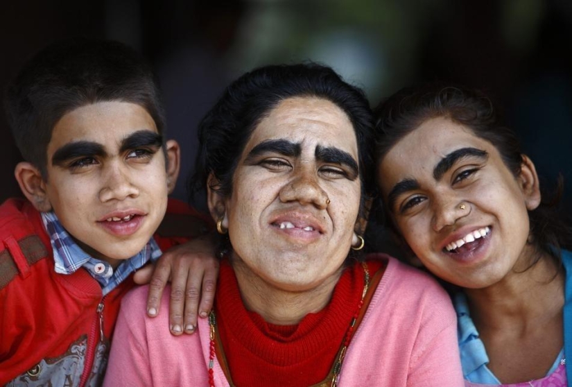 Personas lobo, víctimas de hipertricosis, se sometieron a depilación láser