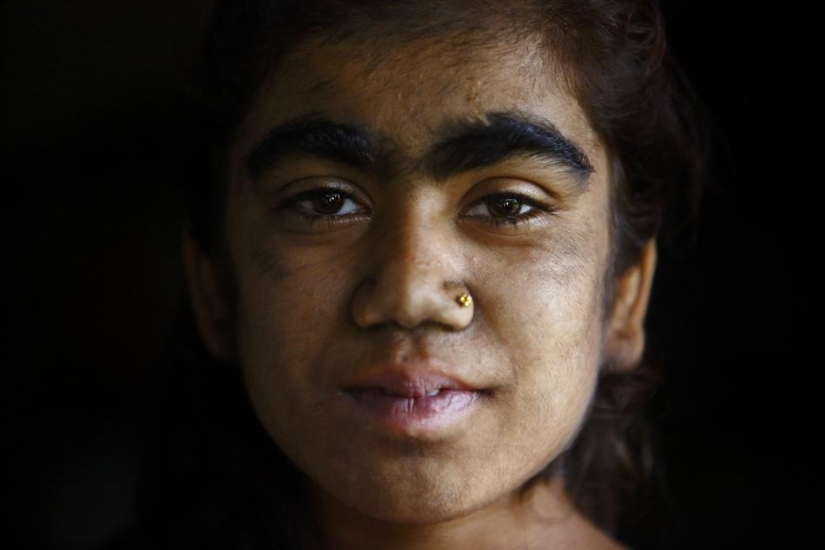Personas lobo, víctimas de hipertricosis, se sometieron a depilación láser