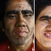 Personas lobo, víctimas de hipertricosis, se sometieron a depilación láser Personas lobo, víctimas de hipertricosis, se sometieron a depilación láser