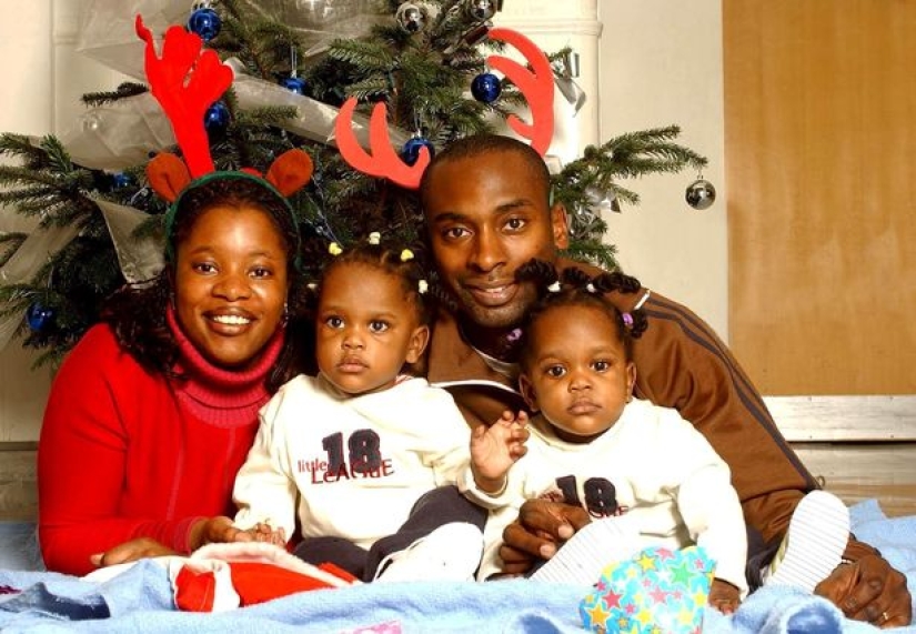 Siamese twins separated in infancy continue to sleep the same way as before the operation