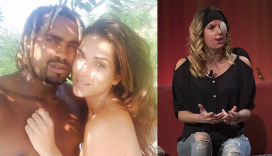 The beauty queen, who was doused with acid by her ex-fiance, showed a disfigured face