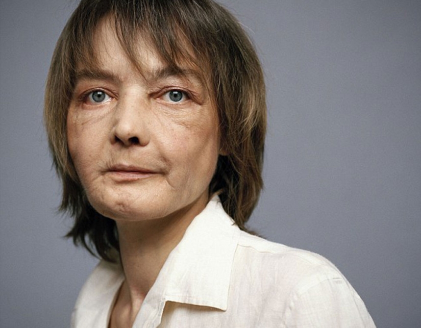 The first woman with a transplanted face died of cancer caused by anti-rejection drugs The first woman with a transplanted face died of cancer caused by anti-rejection drugs