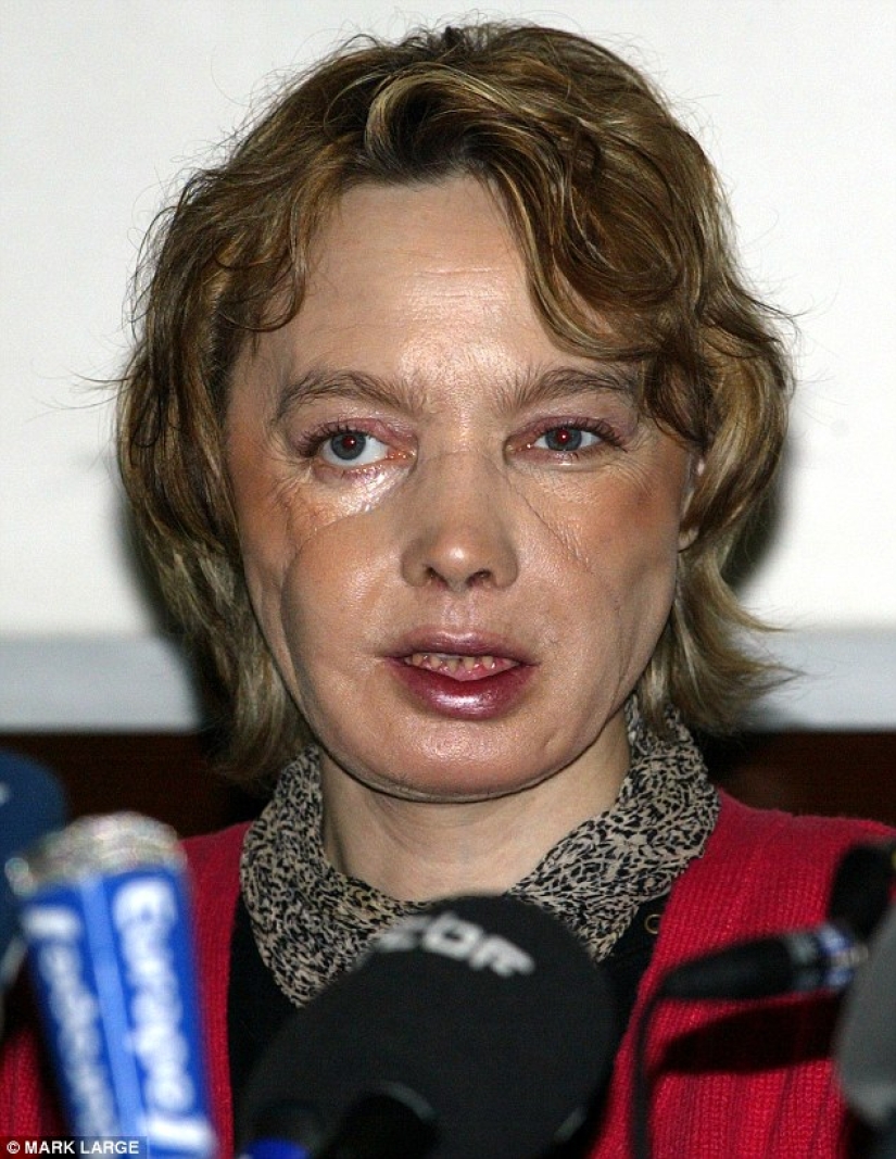 The first woman with a transplanted face died of cancer caused by anti-rejection drugs The first woman with a transplanted face died of cancer caused by anti-rejection drugs